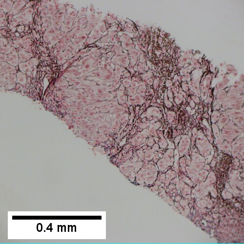 Reticulin with bridging necrosis (100X).