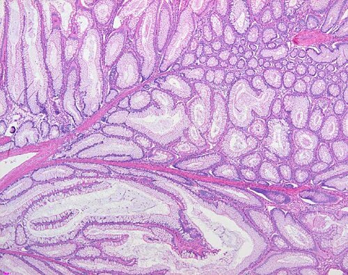 Colon histology with Peutz-Jeghers polyp.jpg