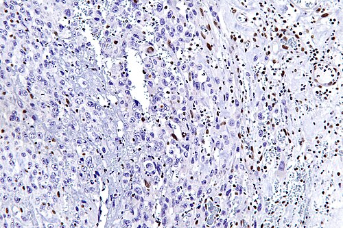 Epithelioid sarcoma - smarcb1 - high mag.jpg