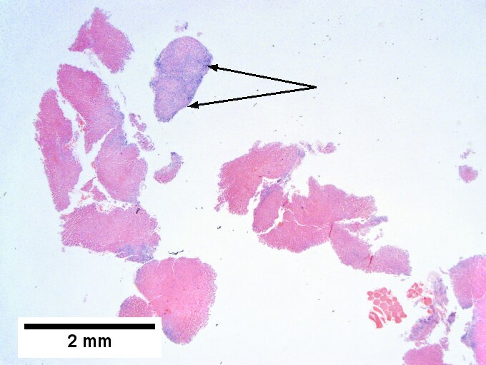 Hepatitis B virus. Metavir activity index 3 {PMN 2 LN 2]. Metavir fibrosis stage 4 (advanced fibrosis/cirrhosis).