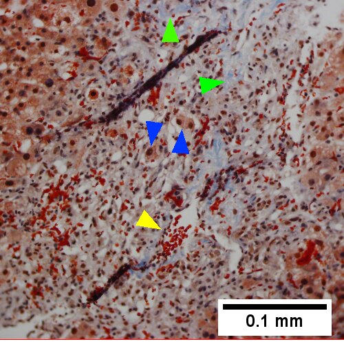 Trichrome highlights fibrosis about central vein [yellow arrowhead] & shows beginning scar formation [green arrowheads]. Note residual atrophic hepatocytes [blue arrowheads] (400X).