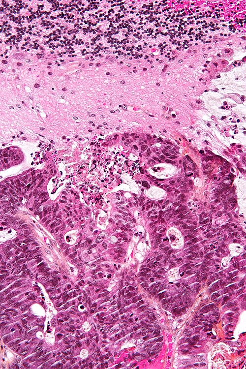 Metastatic adenocarcinoma - cerebellum - high mag.jpg