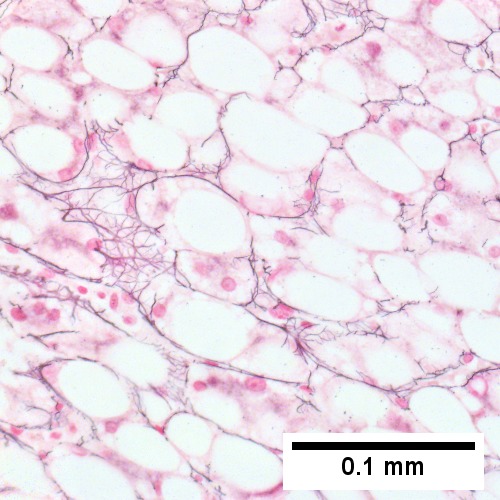 Steatohepatitis. Brunt necroinflammatory grade 2. Brunt fibrosis stage 2.