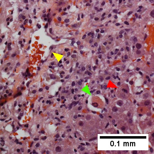 Necrosis with central vein [yellow arrowhead], inflammatory cells, residual Councilman body [green arrowhead], and hepatocyte with mitotic figure [red arrowhead] (400X).