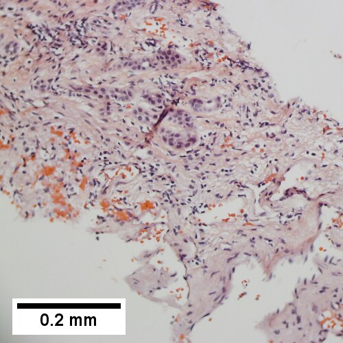 Tortuous bile ductules, not to be considered generalized in presence of mass (200X).