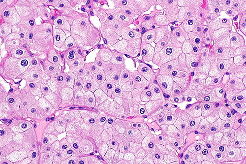 Eosinophilic variant of chromophobe renal cell carcinoma -- high mag.jpg