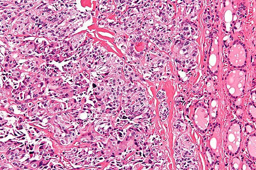 Medullary thyroid carcinoma - high mag.jpg