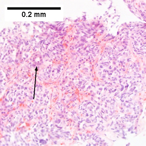 Metastatic poorly differentiated neuroendocrine carcinoma of pulmonary origin.