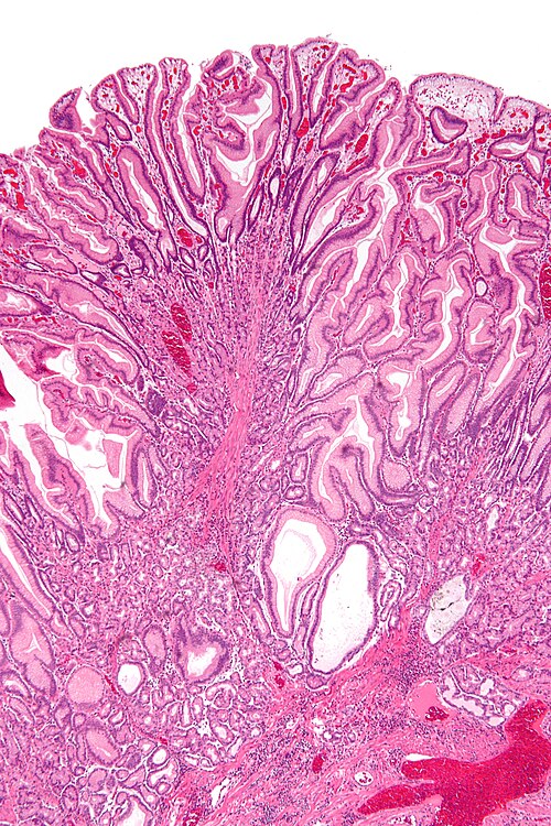 Gastric Peutz-Jeghers polyp - low mag.jpg