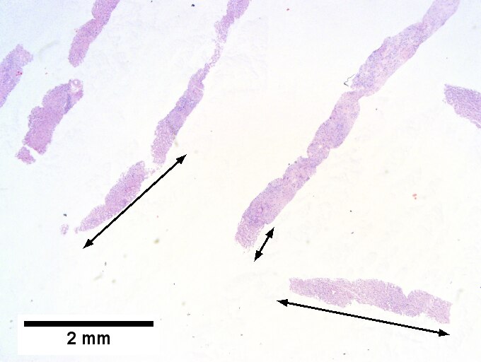 Hepatic sarcoidosis in a patient with previously known sarcoidosis.