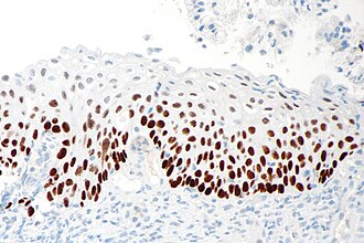 p63 IHC
