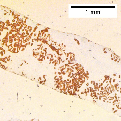 Cholangiocarcinoma, intrahepatic, large duct type.