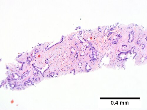 Cholangiocarcinoma, intrahepatic, small duct type.