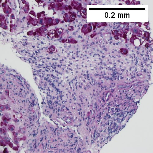 PAS without diastase shows triad lacking bile duct and piecemeal necrosis (200X).