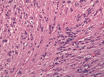 Tanicytic ependymoma x10.jpg