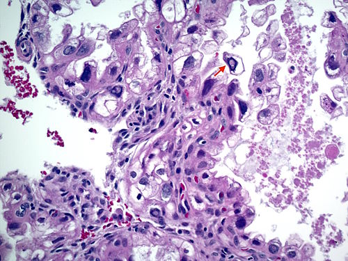 Ariasstella changes in endometrium 20x.jpg