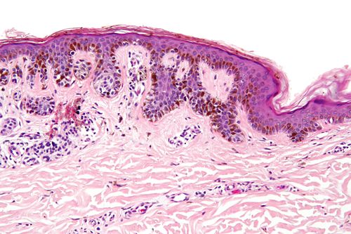 Dysplastic nevus - add - high mag.jpg