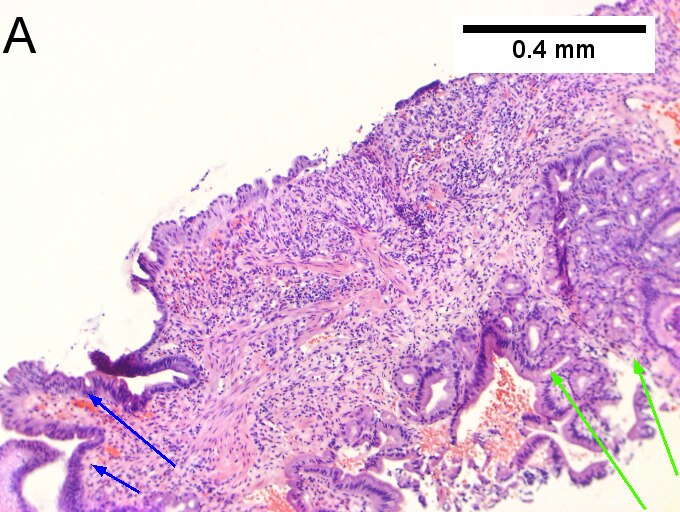 Invasive carcinoma of duodenal ampulla.