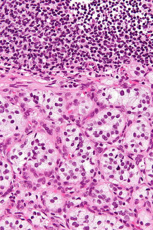 Paraganglioma - very high mag.jpg