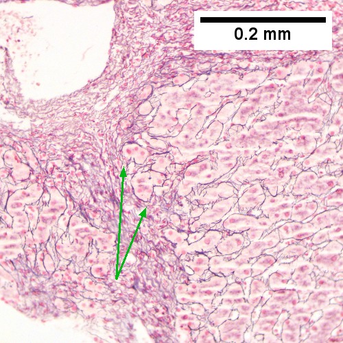 HCR. Metavir Activity Index 2 (PMN 1 LN 2) Metavir fibrosis stage 3.