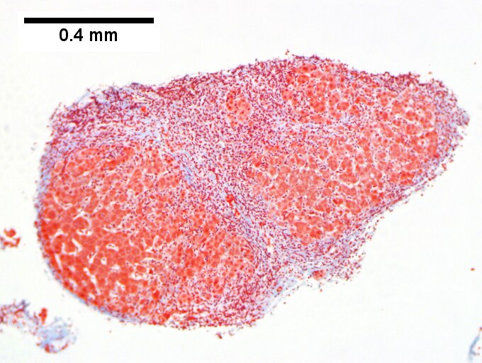 Hepatitis B virus. Metavir activity index 3 {PMN 2 LN 2]. Metavir fibrosis stage 4 (advanced fibrosis/cirrhosis).