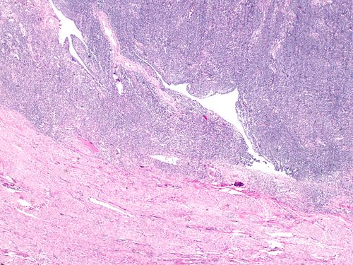 Highly cellular leiomyoma junction of tumor to myometrium at 20x.jpg