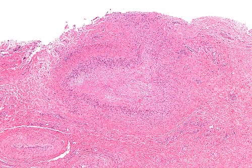 Rheumatoid nodule - low mag.jpg