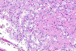 Eosinophilic, solid and cystic renal cell carcinoma - 3 -- intermed mag.jpg