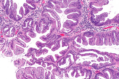 Traditional serrated adenoma -- intermed mag.jpg