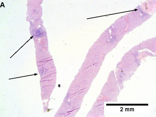 Drug induced liver injury in a young adult man
