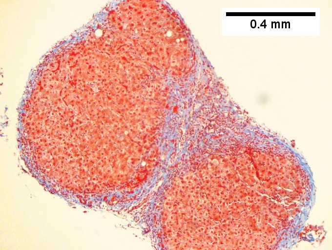 Hepatitis C virus. Metavir activity index 3 (PMN 2, LN 2). Metavir stage 4 (cirrhosis, definite by old criteria).