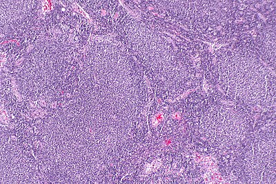 Follicular lymphoma -- low mag.jpg