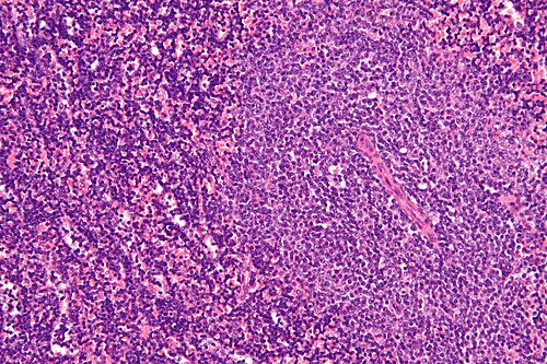 Chronic lymphocytic leukemia - high mag.jpg
