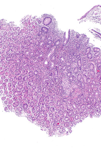 Crohn's gastritis -- low mag.jpg