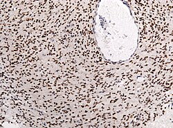 K27M mutant diffuse glioma of the midline.jpg