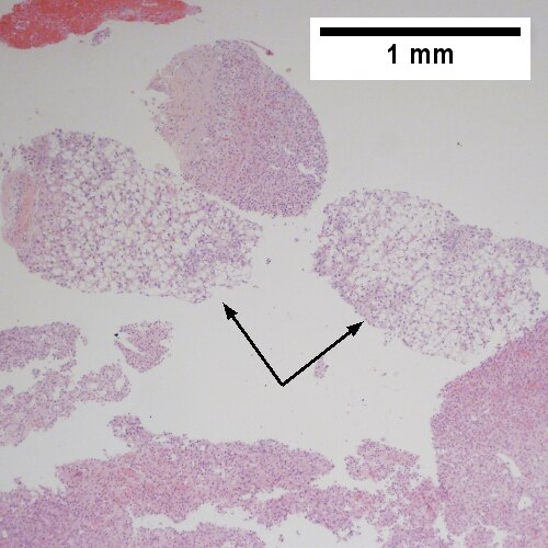 Hepatocellular carcinoma with fragments of liver afflicted by steatosis & with regenerative, benign fragments.