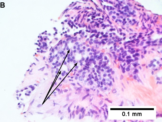 Metastatic thyroid carcinoma to liver