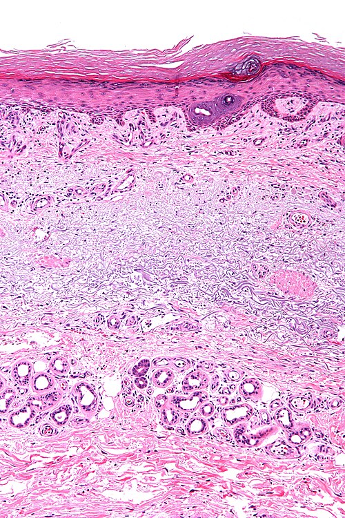 Solar elastosis - intermed mag.jpg