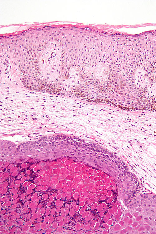 Molluscum contagiosum - high mag.jpg