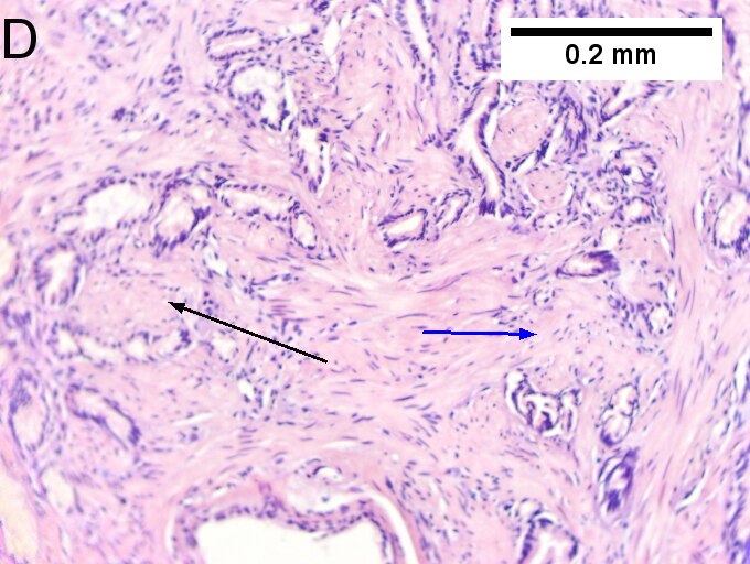 Invasive carcinoma of duodenal ampulla.