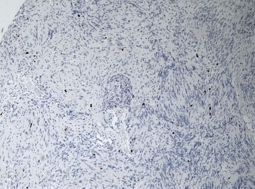 Neuropathology case I-Gomorri 06.jpg