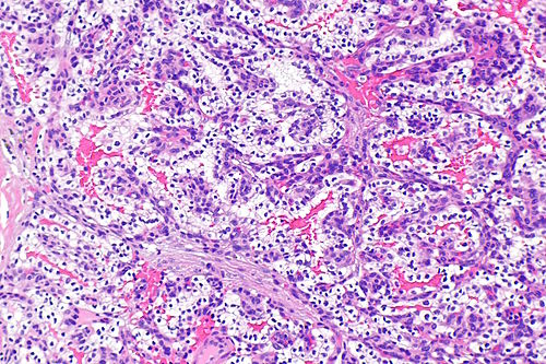 Papillary cystadenoma of epididymis -- intermed mag.jpg