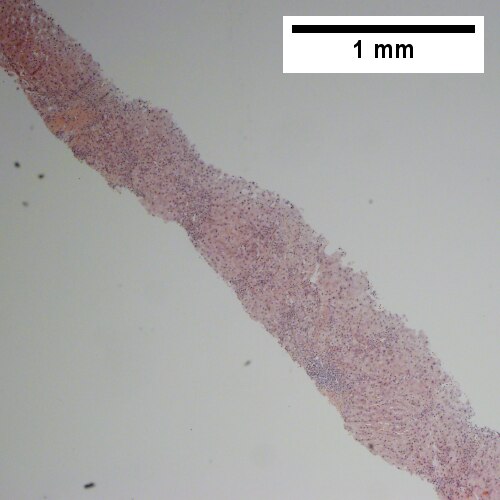 Portal triads, expanded, inflamed and without sharp edges. Inflammation amid hepatocytes. (40X).