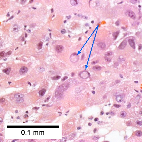 Nuclear inclusions are occasionally prominent [arrows] (Row 2 Right 400X).