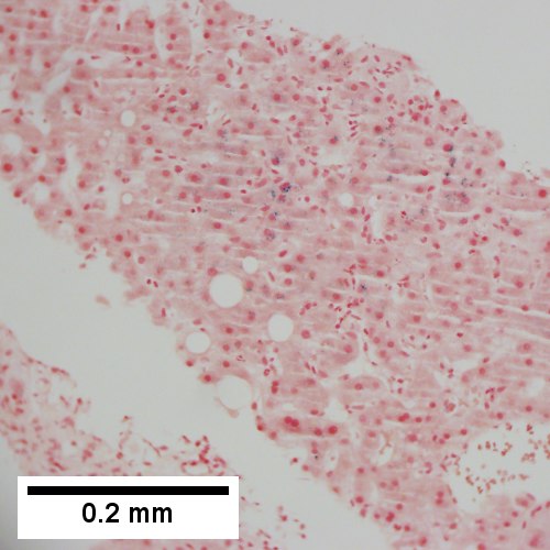 Iron stain shows isolated focus of hepatocytes with cytoplasmic blue granules (200X)