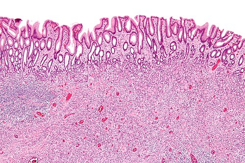 Inflammatory fibroid polyp - low mag.jpg