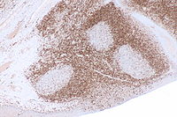 Follicular lymphoma - control bcl2 -- low mag.jpg