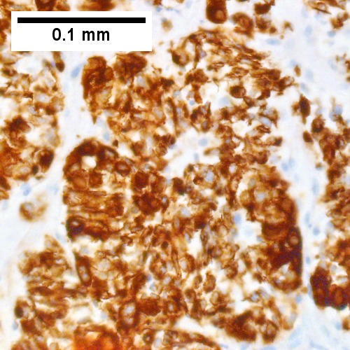 Metastatic poorly differentiated neuroendocrine carcinoma of pulmonary origin.