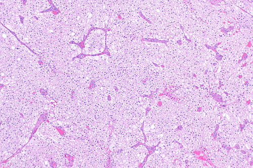 Chromophobe renal cell carcinoma -- low mag.jpg