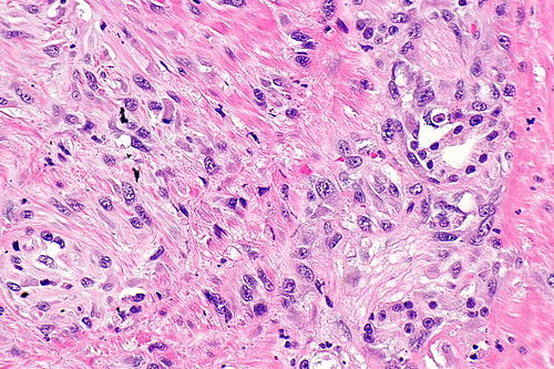 Sarcomatoid prostate carcinoma -- high mag.jpg